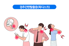 경추간판탈출증(목디스크)